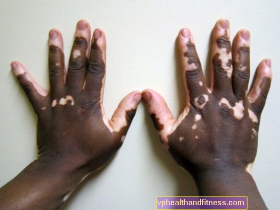 Vitiligo - priežastys, simptomai, gydymas