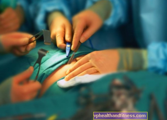 Rasvumise kirurgiline ravi: bariaatrilise kirurgia tüübid
