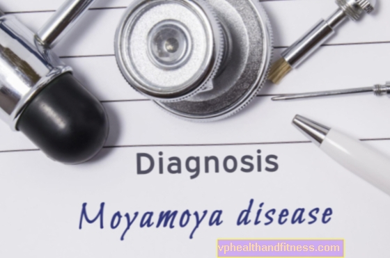 Ziekte van Moyamoy: oorzaken, symptomen, behandeling