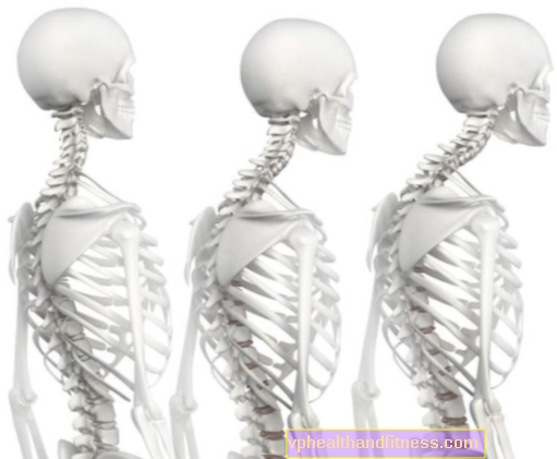 Болест на Scheuermann (стерилна некроза на гръбначния стълб) - причини, симптоми и лечение