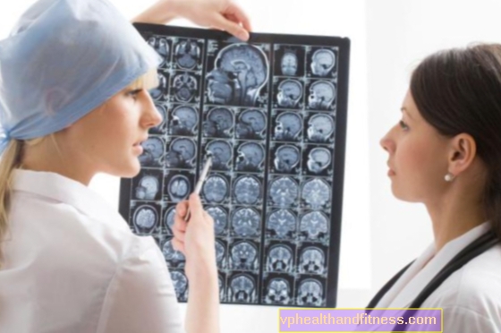Bolezni malih možganov lahko vodijo do okvare