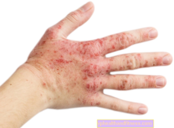 Тежка хронична екзема на ръцете - причини, симптоми и лечение