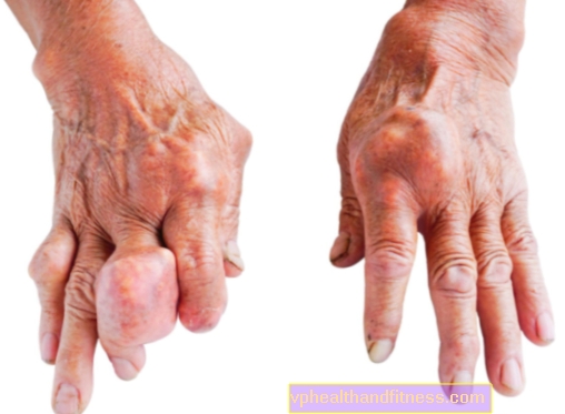 Gota (gota, artritis): causas, síntomas, tratamientos
