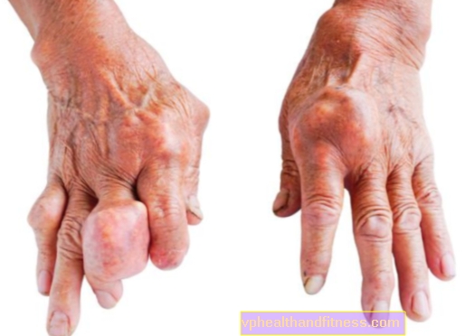 artritis, artroza liječenje uzroka