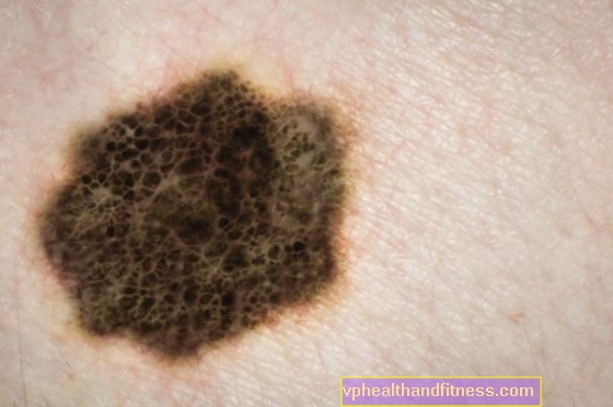 Ärftlig malignt melanom: indikationer för genetisk undersökning
