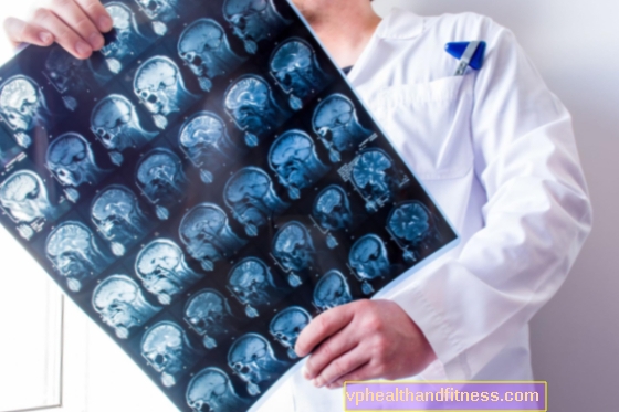 Diabētiskā encefalopātija: cēloņi, simptomi, ārstēšana