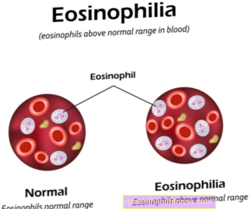 Eosinofilia: tipos y causas