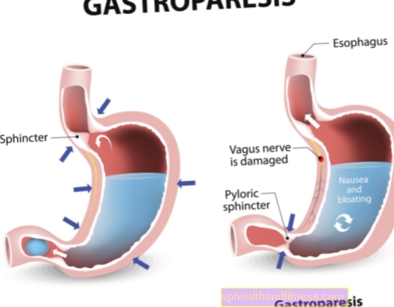 Gastroparesia: causas, síntomas, tratamiento