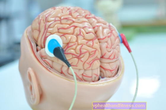 Estimulación cerebral profunda en el tratamiento de la enfermedad de Parkinson