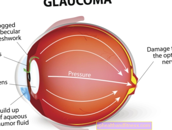 Когато говорим за глаукома, профилактиката е най-важна