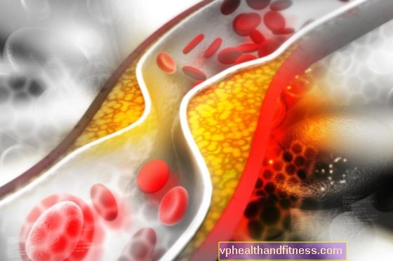 Hiperkoleszterinémia: okok, tünetek, kezelés