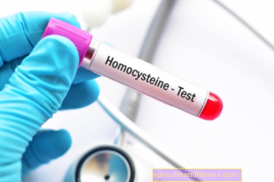 Homocistinuria: causas, síntomas, tratamiento