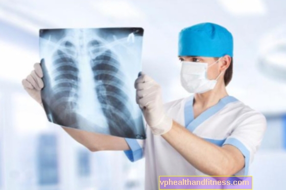 Fibrosis pulmonar idiopática (idiopática): síntomas y tratamiento