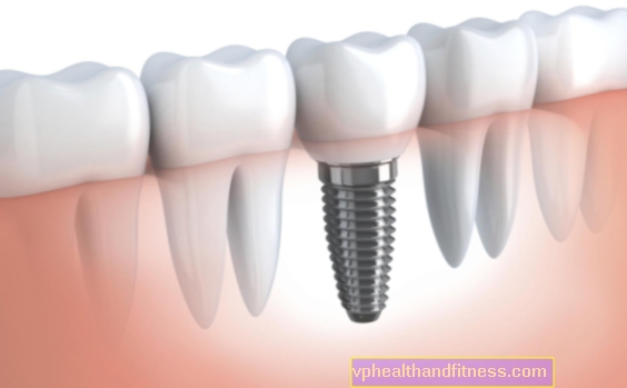 Implantater af titanium eller zirconium - hvilke tandimplantater skal du vælge?