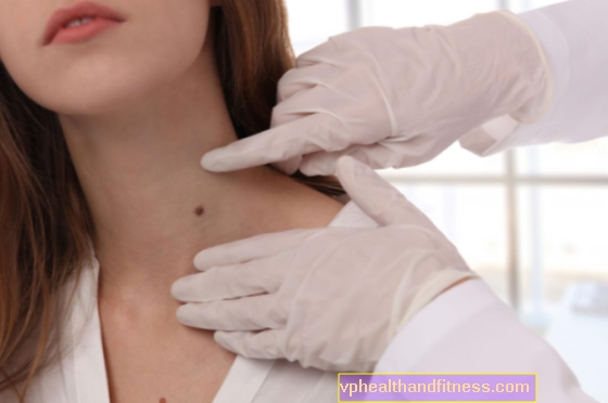 Hvordan beskyttes huden efter fjernelse af melanom? 