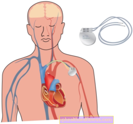 Kardiovertera defibrilators (ICD) - kas tas ir? Kā tas strādā?