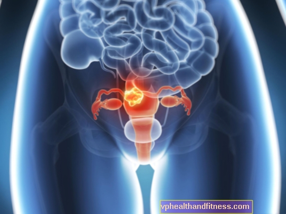 Sarcoma uterino: causas, síntomas, tratamiento