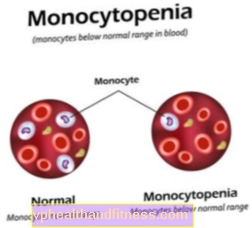 Monocitopenia: causas, síntomas