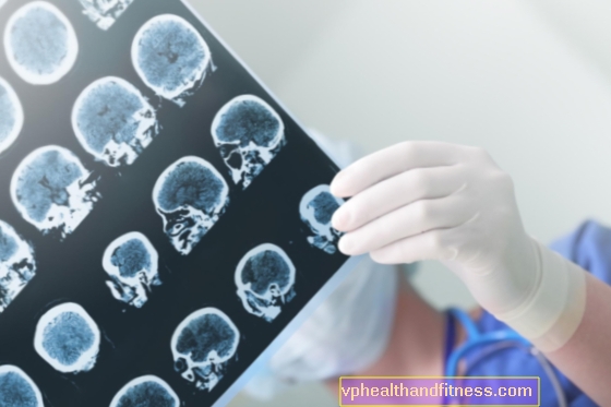 Smegenų hemangiomos - priežastys, simptomai ir gydymas