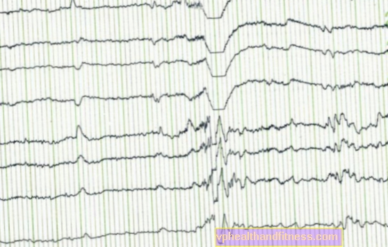 Görcsroham - mit kell tenni epilepsziás roham esetén? Hogyan tudok segíteni egy rohamnál?