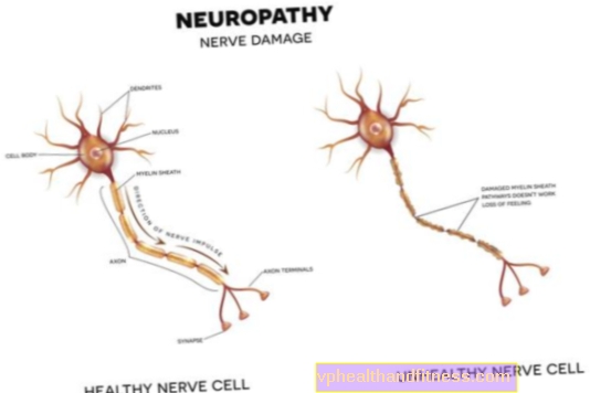 Neuropatía: tipos, causas, síntomas, tratamiento.