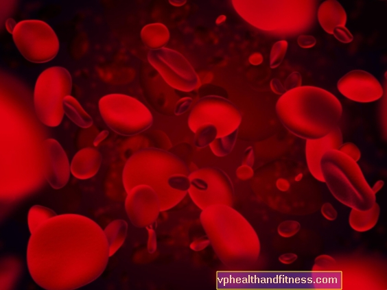 Anemia sideroblastik: penyebab, gejala, dan rawatan anemia sideroblastik