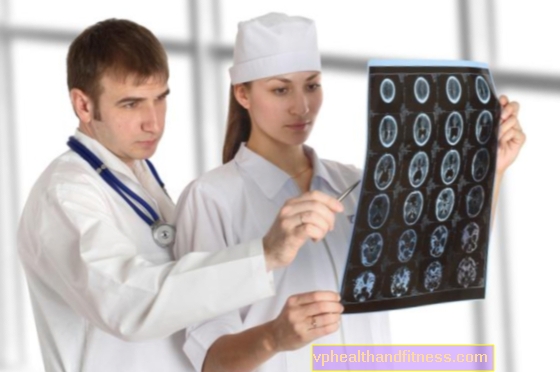 Meningeomen: symptomen en behandeling van goedaardige hersentumoren