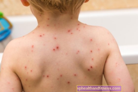 Viruela y culebrilla. ¿La varicela protege contra el herpes zóster?