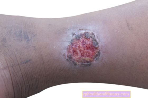 Úlcera venosa de la pierna: causas, síntomas, tratamiento.