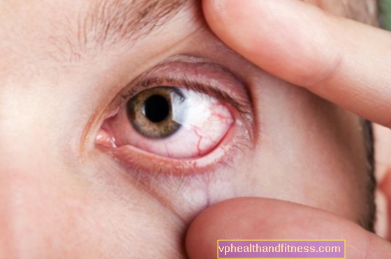 Un capilar roto en el ojo: ¿cuál es este síntoma? Las causas de los capilares rotos en el ojo.
