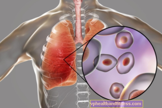 Pneumocystos lunginflammation (pneumocystos): orsaker, symtom, behandling