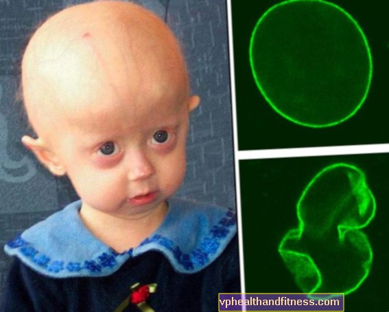 Progeria: vejez prematura. Causas y síntomas del envejecimiento prematuro.