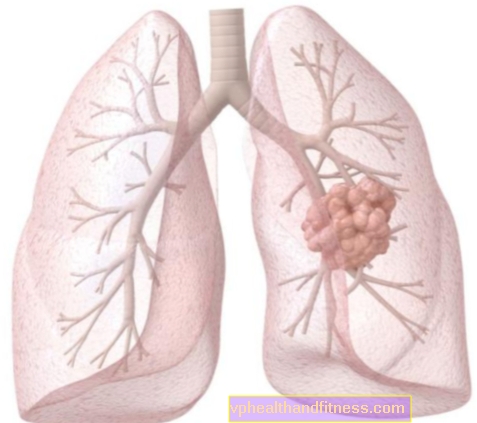 Cáncer bronquial: causas, síntomas, tratamiento y pronóstico
