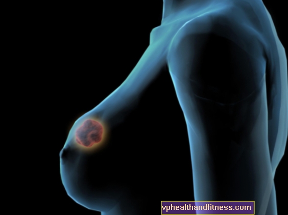 Cáncer de mama como resultado del crecimiento de células en el conducto lácteo.