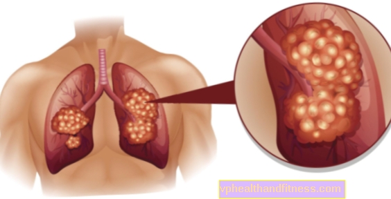 Cáncer de pulmón: causas, síntomas, diagnóstico