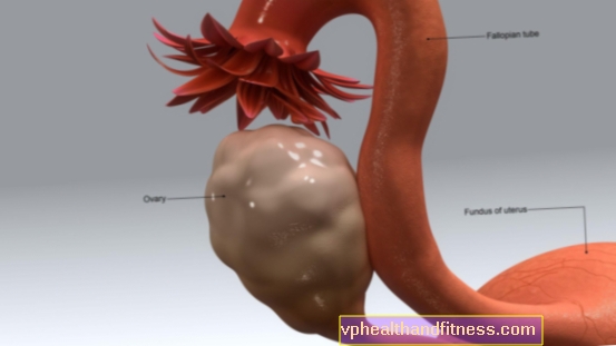 Absceso del ovario, trompa de Falopio: causas, síntomas, tratamiento