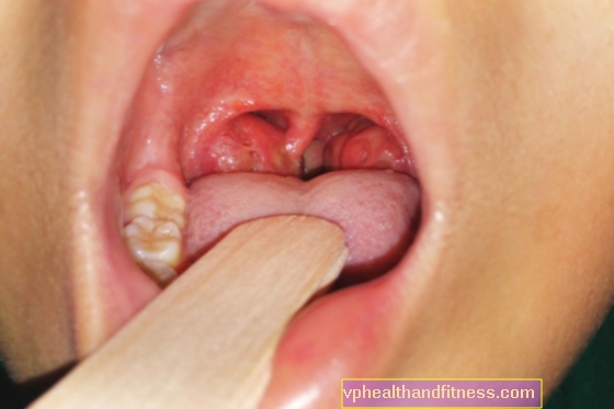 Peritonzilární absces: příčiny, příznaky, léčba