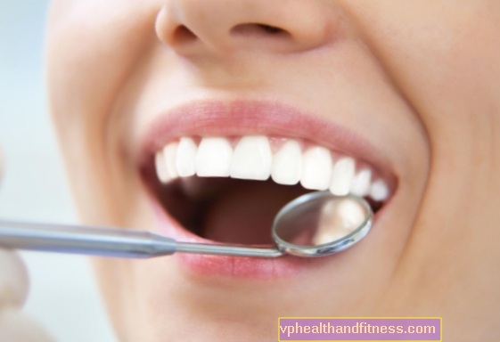 Schalen (verwijderen van tandsteen) - wanneer te doen?