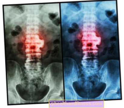 Spondyloosi ja spondyloarthrosis - selkärangan ja nikamien nivelten degeneraatio