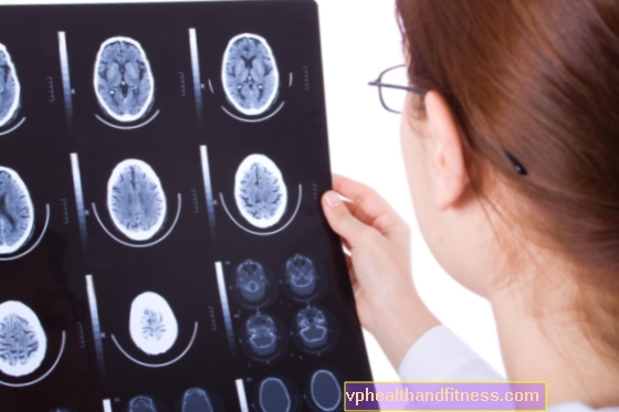 KONTAKT S MOZGY - příznaky a léčba. Jaké jsou komplikace pohmoždění mozku?