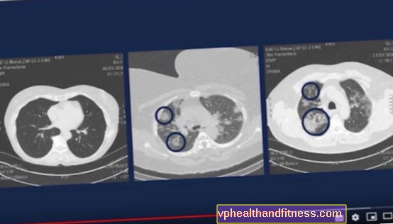 Estos son los pulmones de un paciente con COVID-19. Comentario de los médicos: terrible
