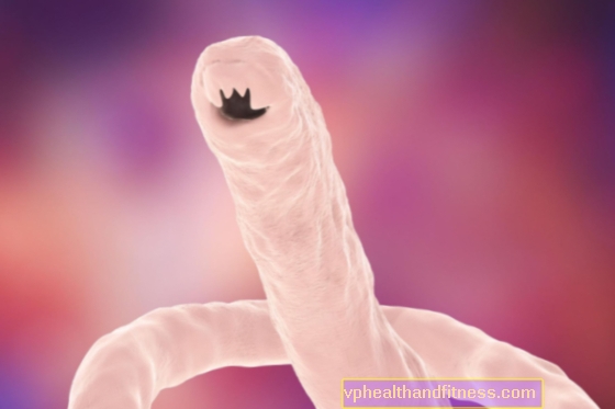Duodenal hookworm: prevencia, príznaky, liečba