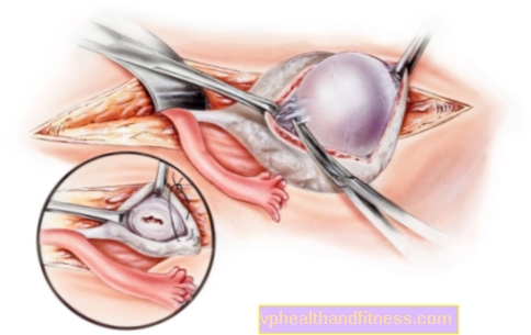 Ovarial dermal cyste: årsager, symptomer, behandling