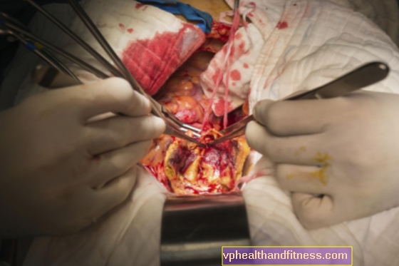 Aneurisma de aorta abdominal: causas, síntomas y tratamiento