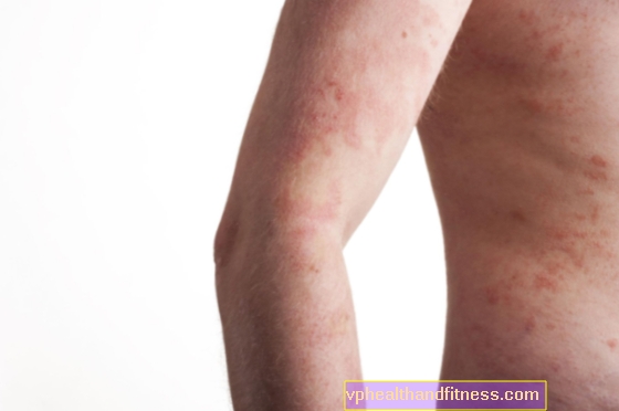 Spotted tyfus (tyfus, utslett tyfus) - en sykdom overført av lus og lopper