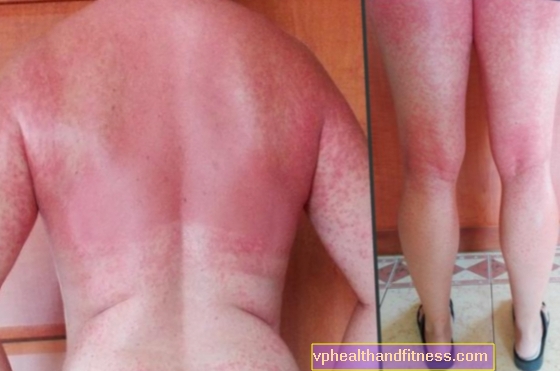 Alergia al sol después de antibióticos: fotos