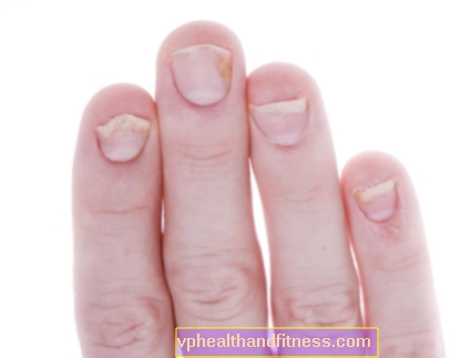 손톱 건선-원인과 증상. 손톱 건선을 치료하는 방법?