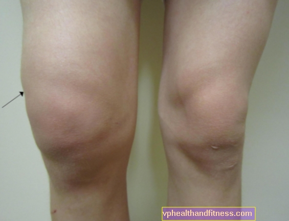 Agua en la rodilla: ¿cómo reconocer los síntomas de derrame en la articulación de la rodilla?
