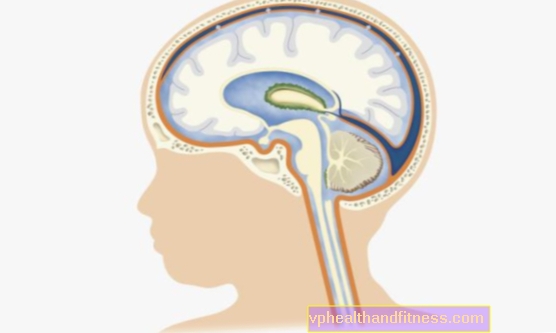 Hidrocefalus - uzroci i simptomi. Liječenje hidrocefalusa