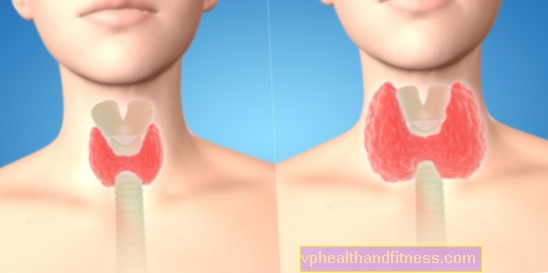 Goitre neutre de la glande thyroïde: causes, symptômes, traitement
